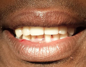 after porcelain crowns