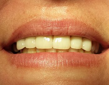 after cosmetic bridge