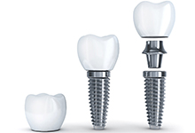 A digital image showing the various parts of a dental implant