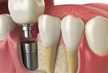 dental implant post, abutment, and crown in the jaw