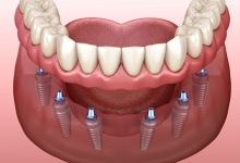 implant dentures on bottom arch 
