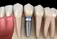 single dental implant post in the jawbone