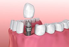 crown being placed over a dental implant