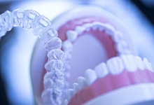 Invisalign aligners next to a model of a mouth