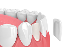 Illustration of porcelain veneer