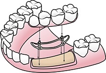 illustration of crown and bridge