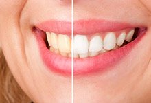 before and after teeth whitening