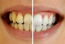 before and after teeth whitening