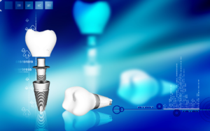 dental implant