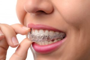 woman inserting Invisalign aligner in mouth