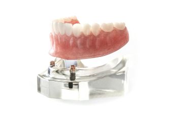 An implant-retained denture