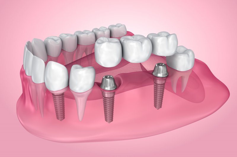 Dental implant bridge